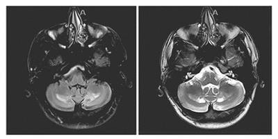 Cerebrotendinous xanthomatosis tremor successfully controlled post-ventral intermediate nucleus-deep brain stimulation: a case report